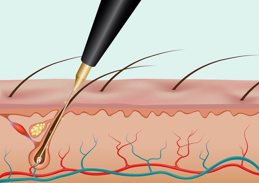 Permanent Hair Removal in Madison Evolve Electrolysis Center